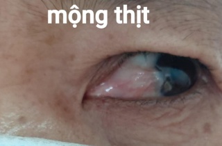 BỆNH MỘNG THỊT TẠI MẮT CÓ THỂ PHẪU THUẬT SỚM